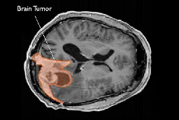 Prolonged use of certain hormone drugs linked to increased brain tumor risk