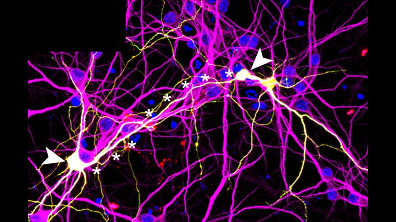 Study finds that COVID-19 could cause brain cells to fuse, leading to permanent damage