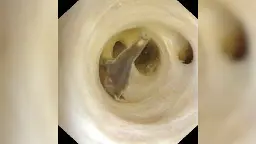 Watch parasitic worms get pulled from man's abdomen after surprise discovery during routine surgery