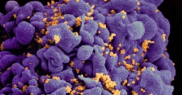 CRISPR cure for HIV now tested in 3 people